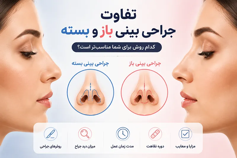 تفاوت جراحی بینی باز و بسته